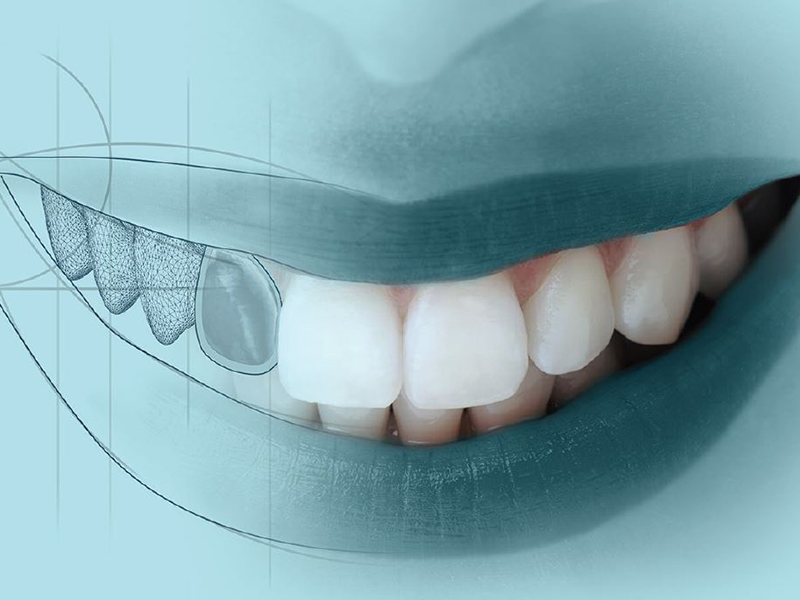 Digital Dental Fotoğraf ve Mock Up Uygulamaları